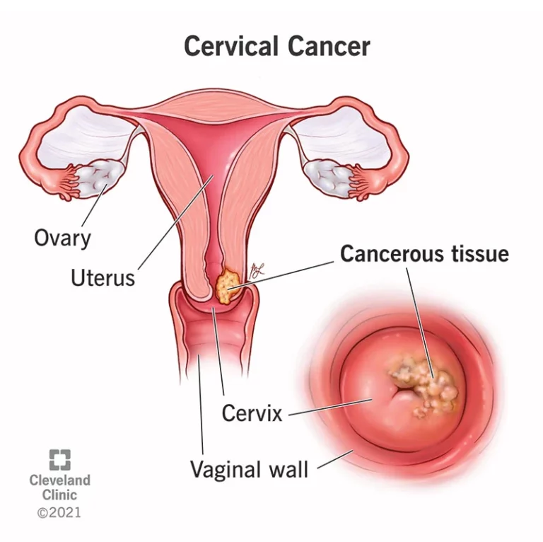 FG to begin HPV vaccination against cervical cancer for girls, Oct 24